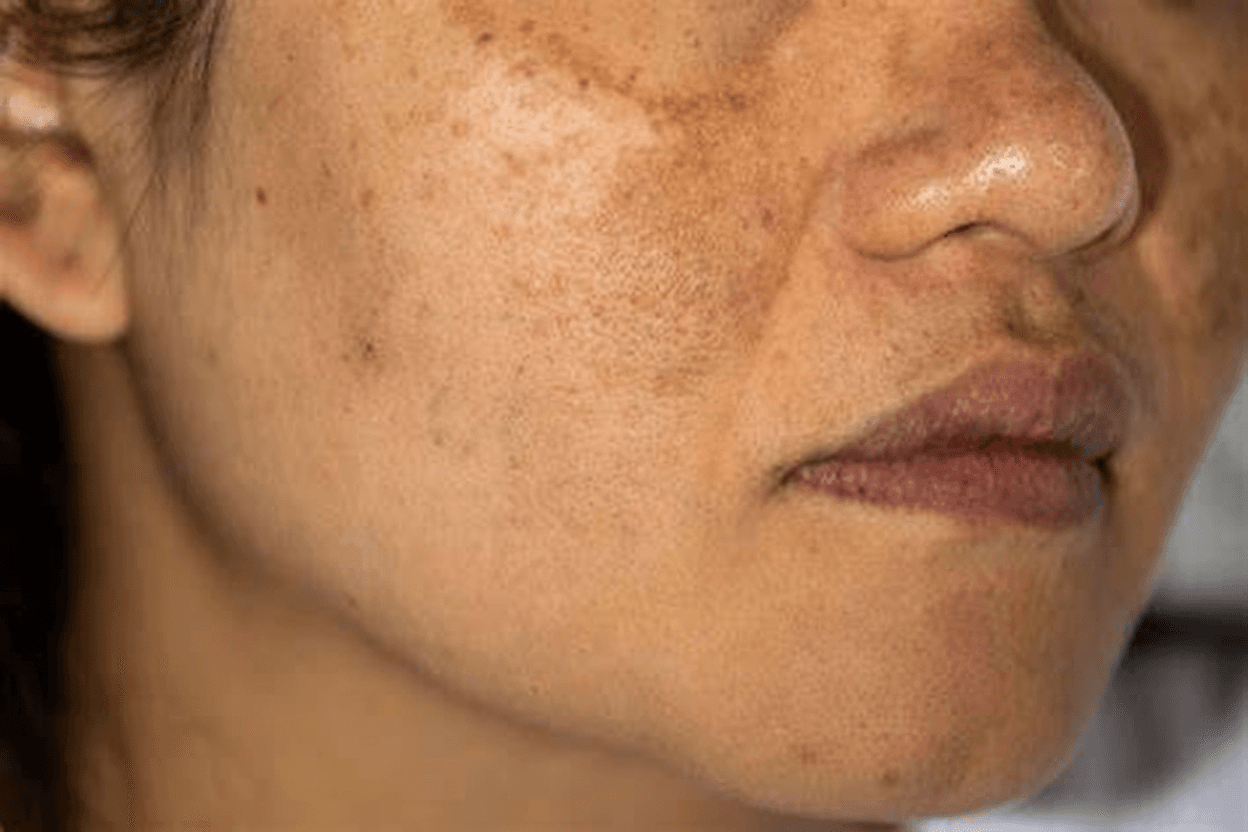 Pigmentation